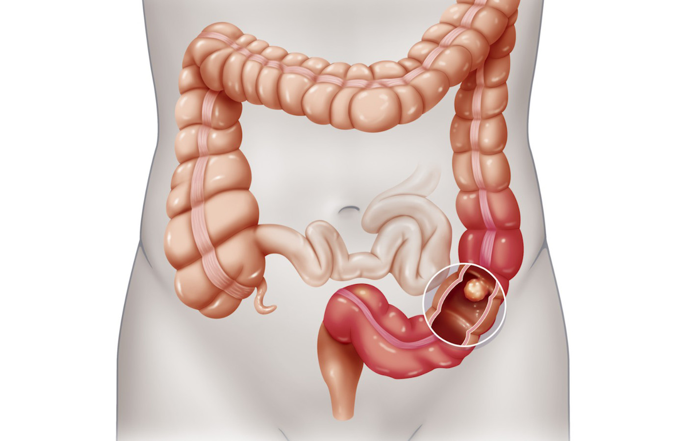 Colon Cancer; Early Detection and Lifestyle