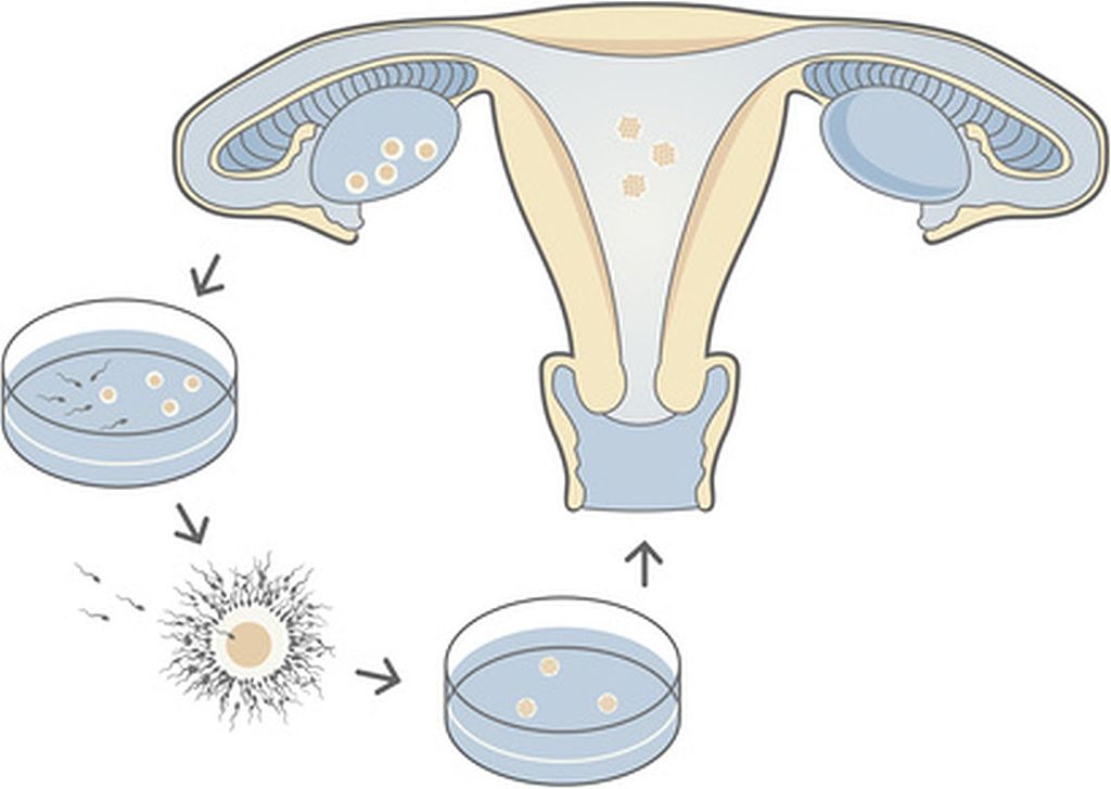 In vitro fertilization IVF